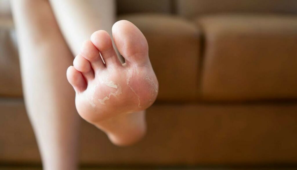 baby foot peel