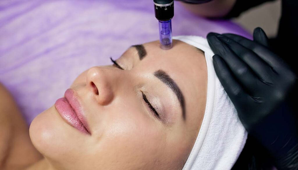 woman getting micro needling 