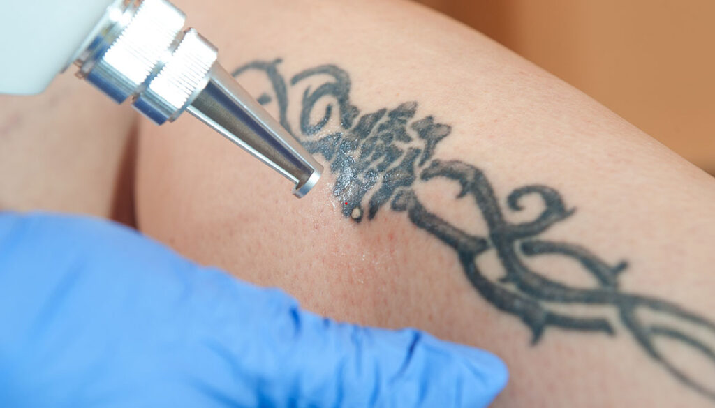 Laser tattoo removal