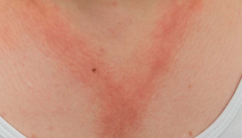 allergic contact dermatitis red rash in shape of necklace on a woman's neck