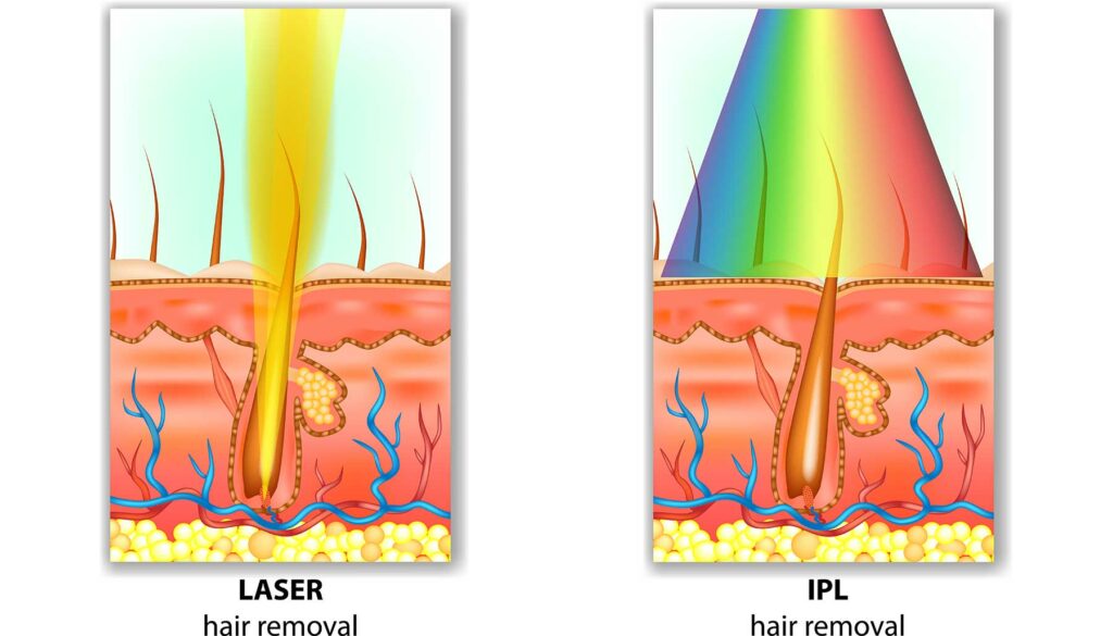 laser hair removal vs IPL