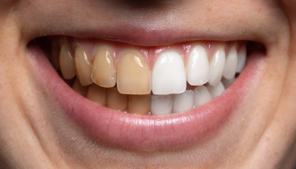 Teeth whitening concept with half teeth stained and half whitened