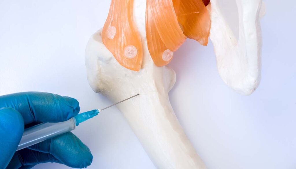 Bone marrow examination procedure: biopsy, aspiration or paracentesis concept photo. Doctor holds in hand dressed in glove syringe needle and puncture model of hip bone to take analysis of bone marrow